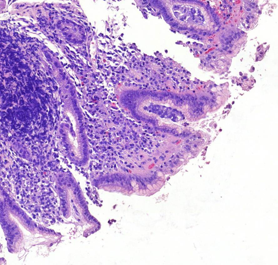 gastritis chronica metaplasia