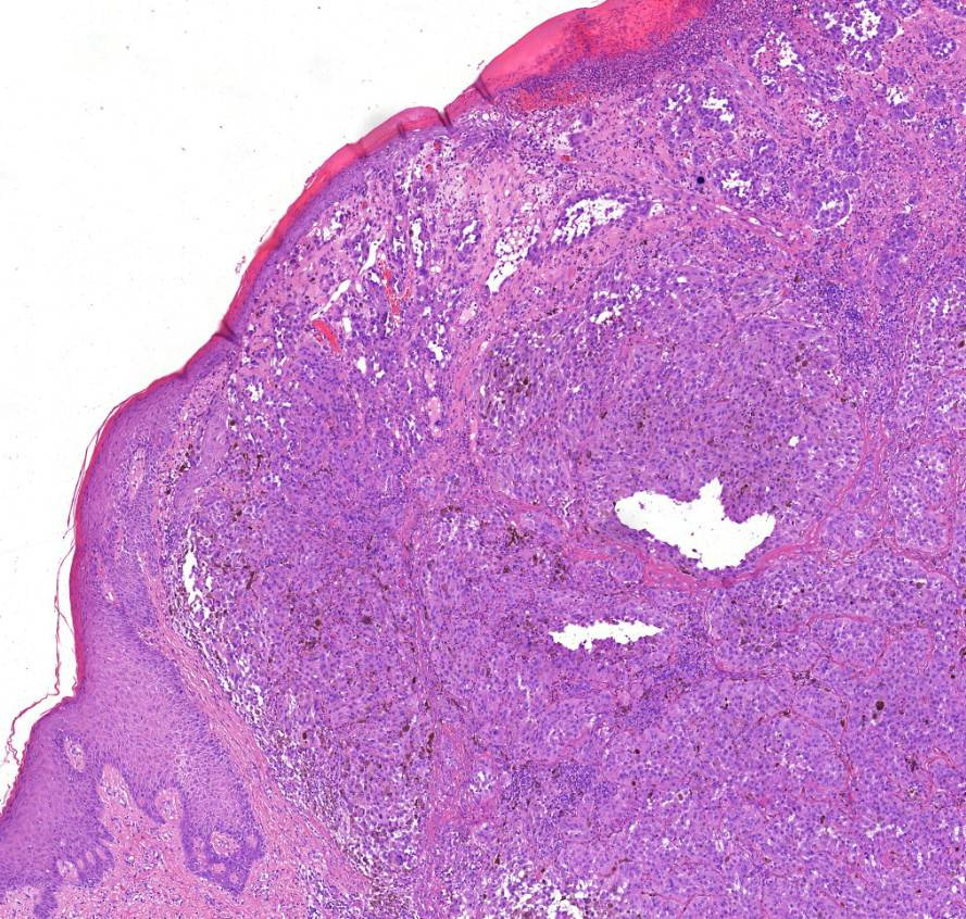 Melanoma malignum cutis epidermis eltunik