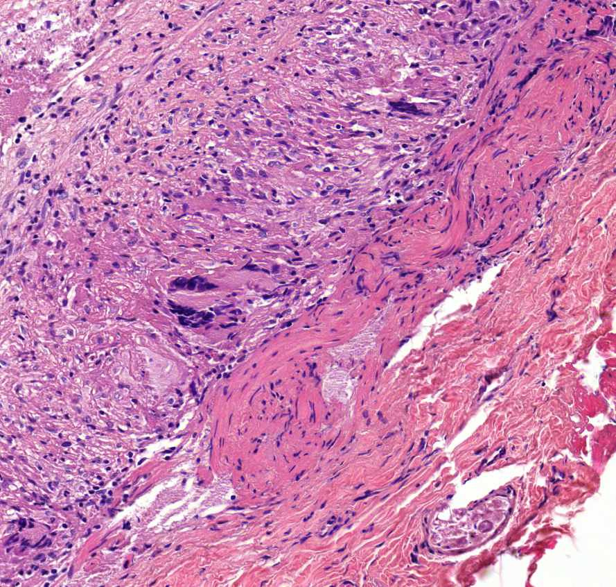 arteritis1