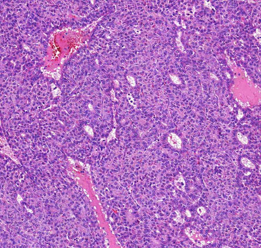 Carcinoma hepatocellulare pseudoglandularis