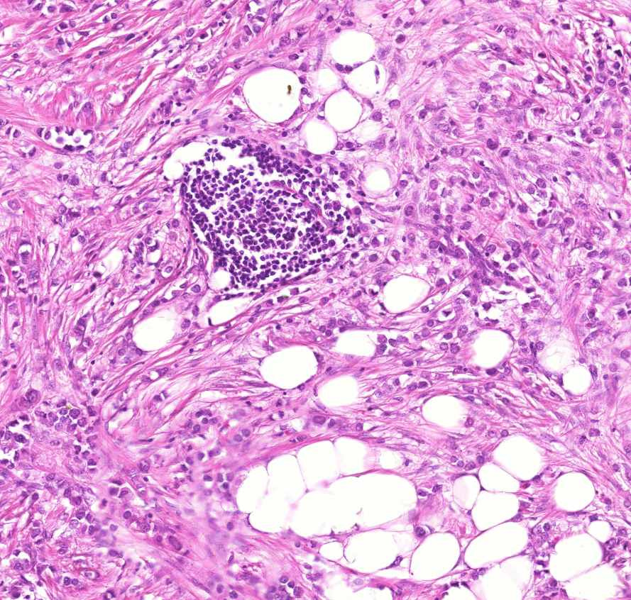 carcinoma lobulare invasivum mammae ly