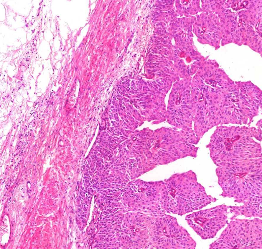 carcinoma transitiocellulare izomréteg 2