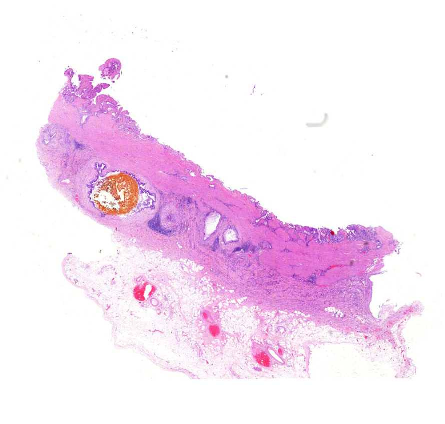 cholecystitis chronica