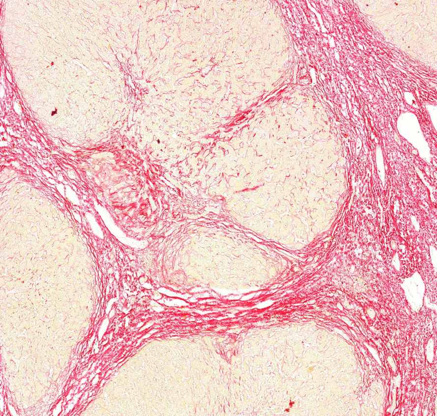 cirrhosis hepatis (picro)2