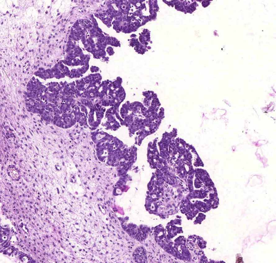 cystadenocarcinoma ovarii papillaris képlet