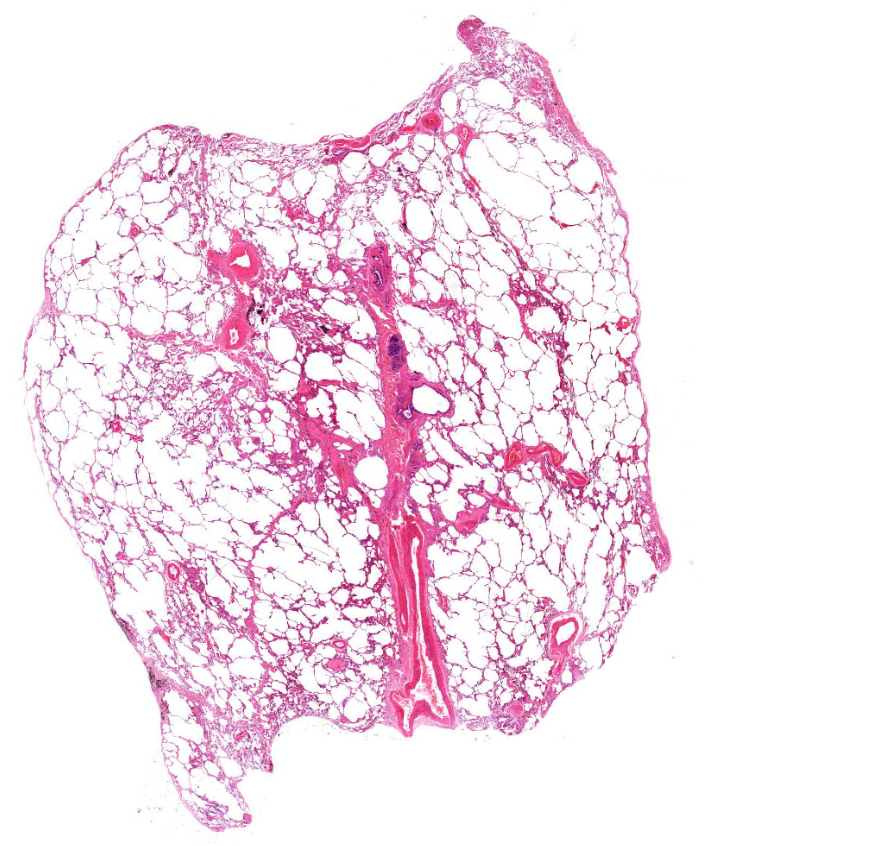 emphysema