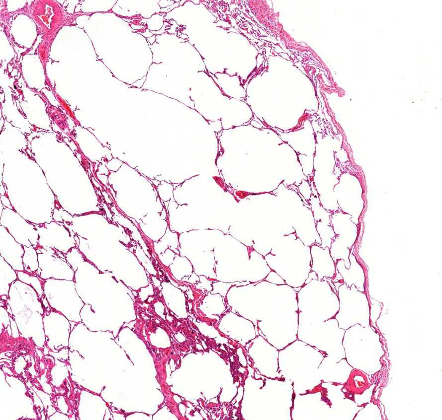 emphysema1