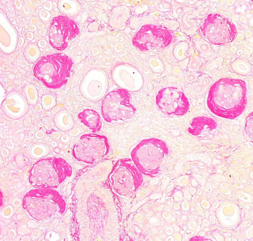 end-stage-kidney (picro)1