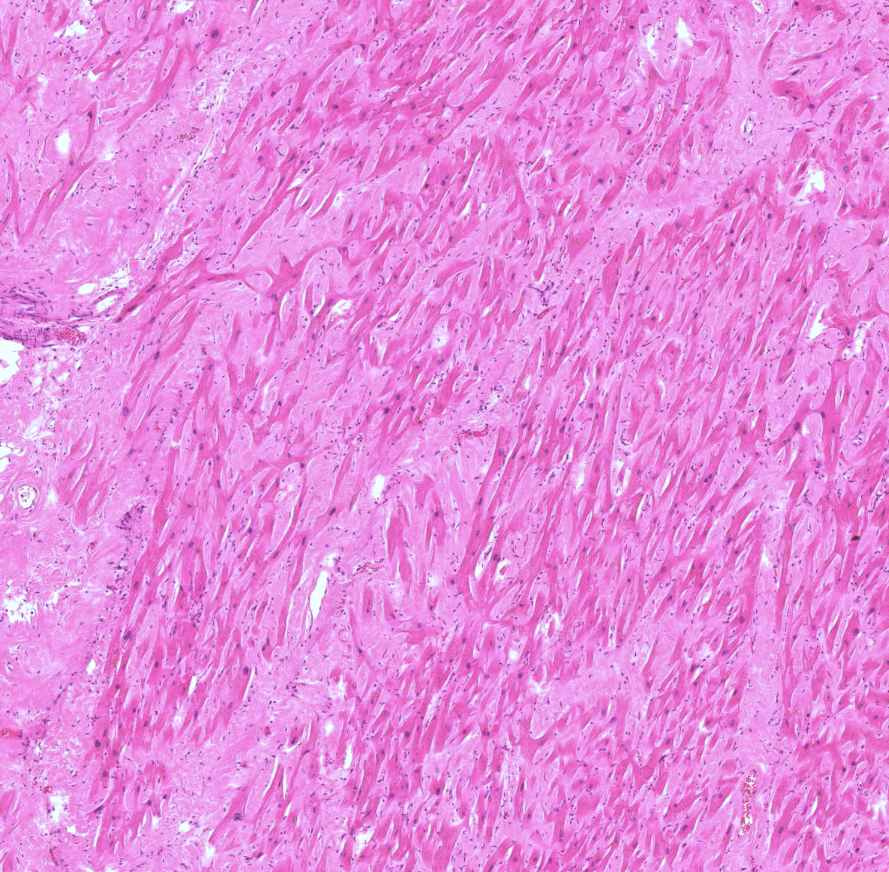 hypertrophias cardiomyopathia0