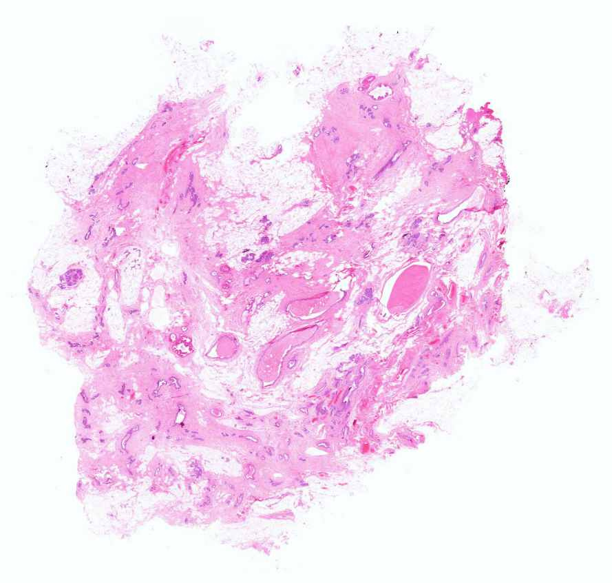 mastopathia fibrocystica