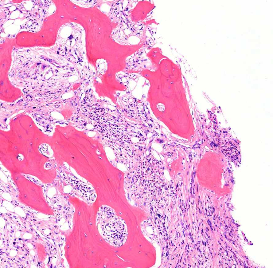 myelofibrosis (HE)0