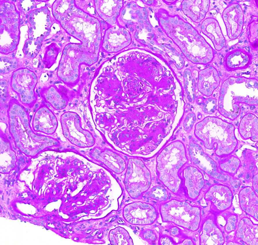 nephropathia diabetica (pas)1