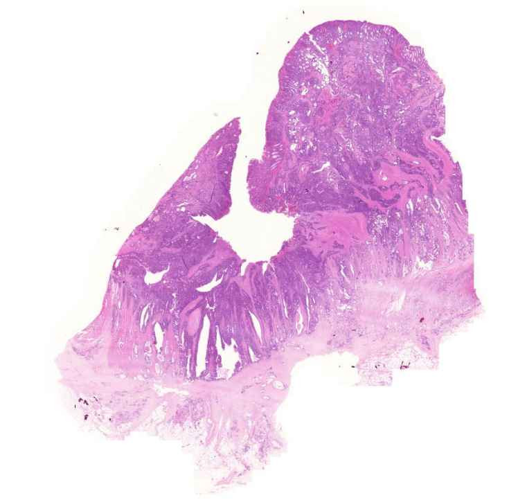 adenocarcinoma coli00