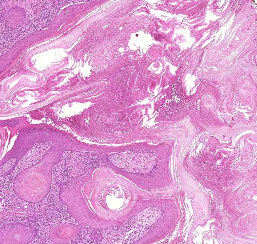 carcinoma planocellulare cutis 3