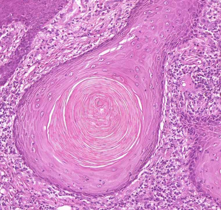 carcinoma planocellulare cutis paraceratozis