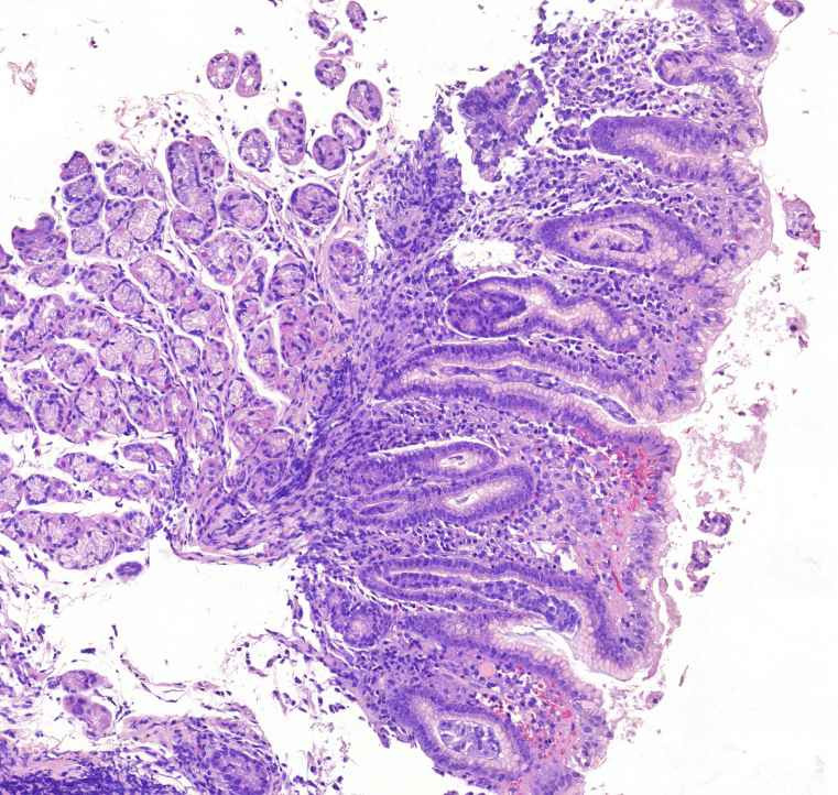 Gastritis chronica1