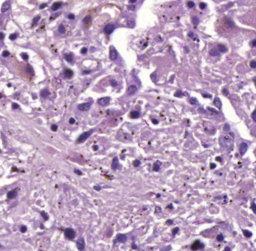 tuberculosis pulmonis ZN pirosbacik